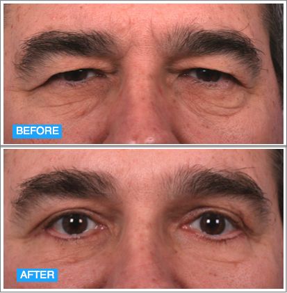 Eyelid Surgery 1d79c281e4cf853e42b6f8983c38518b