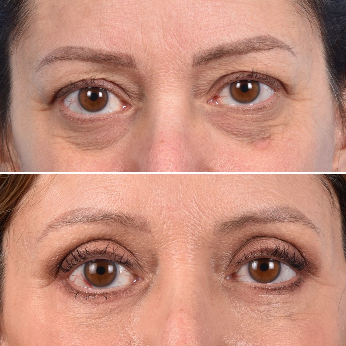 Eyelid Surgery 92e705ef7900e8776558993d214852e3
