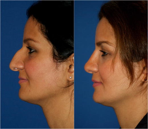 long prominent nose in 35 year old women born in iraq n l angle before operation was 80