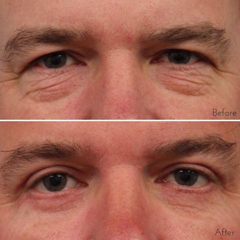 Eyelid Surgery a76a4422b9456ceee4ddc0b9c9871fe0